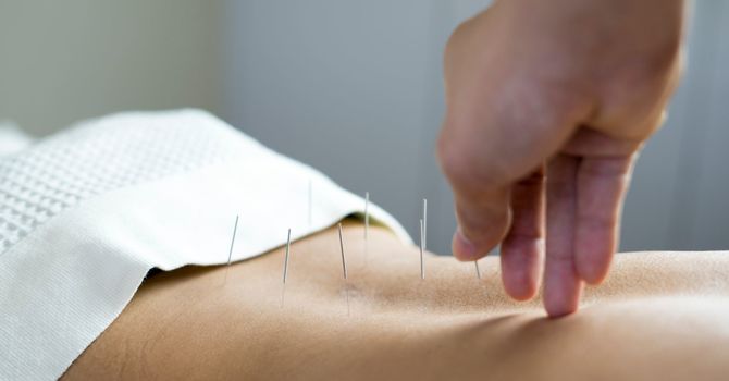 Can Acupuncture Help With Anxiety and Stress? image